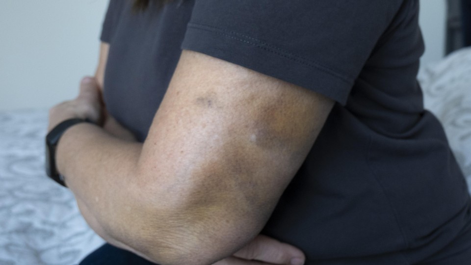 Een vrouw met blauwe plekken zit op een bed. Foto: Helène van Rijn/ANP